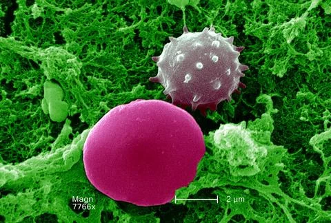  Acanthocyte This scanning electron micrograph (SEM) depicted a number of ... Stock Photos