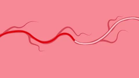 Accelerating the opening and closing of the venous valves, ankle pump exercise Stock Footage 316523544