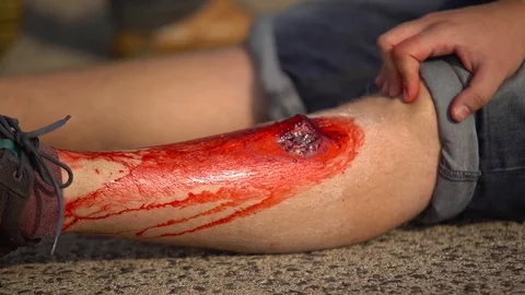 Accident simulation, open bone broke Stock Footage 71437561