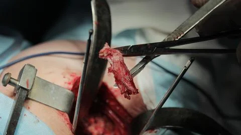 Acetabular Labrum Macro Foto stock