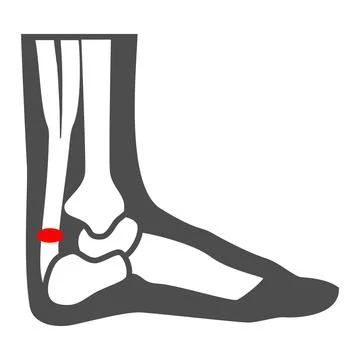 Achilles heel solid icon, Human diseases concept, leg with a sore ankle sign on Stockillustratie
