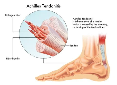 Achilles Tendonitis Stock Illustration