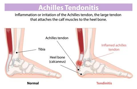 Achilles Tendonitis Illustration Stock Illustration