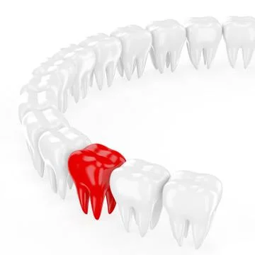 Aching tooth in row of healthy teeth. 3d Stock Illustration
