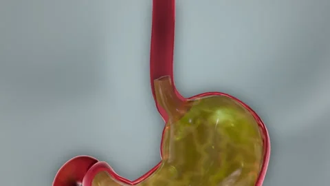 Acid Reflux Disease GERD 3D Animation Stock Footage 278430997