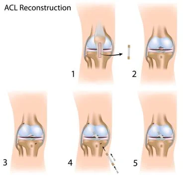 Acl reconstruction Stock Illustration