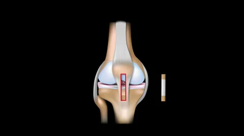 Acl reconstruction surgery Video stock 30191788