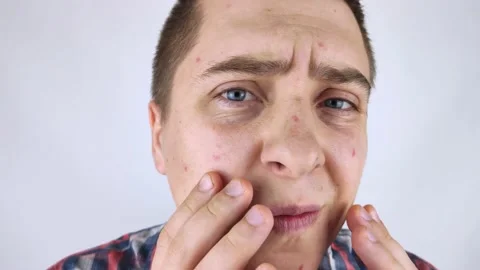 Acne and black dots close-up. The man looks in the mirror and sees acne there. S Video stock 142731871