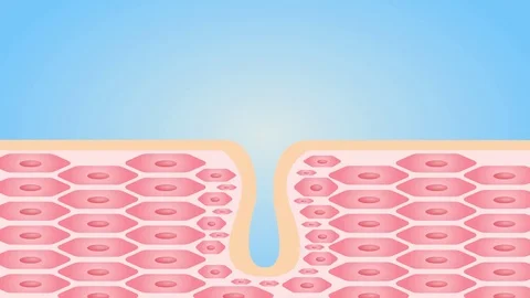 Acne and Pimples, stages of development, graphic 스톡 동영상 79841875