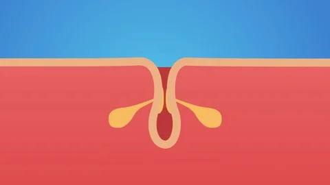 Acne and Pimples, stages of development graphic / skin Stock Footage 79843004