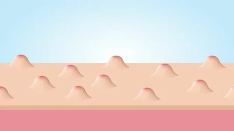 Acne and Pimples, stages of development, graphic animation 스톡 동영상 133119209