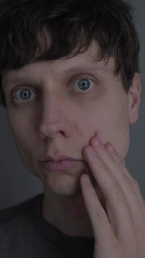 Acne and skin problem. Close up of man touching pimple on face, male skincare Video stock 327743192