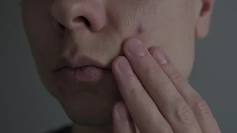 Acne and skin problem. Close up of man touching pimple on face, male skincare Stock Footage 327743391