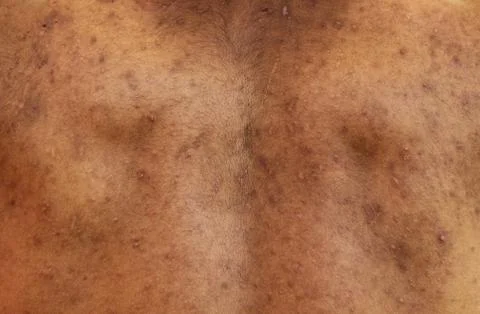 Acne on the back Stock Photos