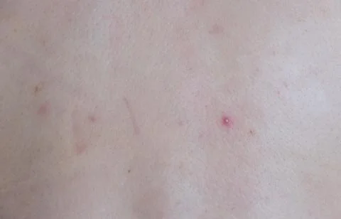 Acne On The Back. Stockfoto's