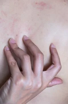 Acne On The Back. Stock Photos