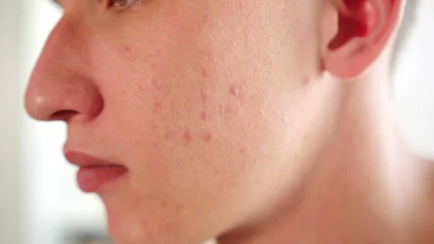 Acne breakouts  on a young mans cheek with skin texture blemishes. Stock-Footage 338175142