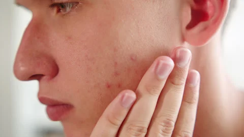 Acne breakouts  on a young mans cheek with skin texture blemishes. Stock-Footage 338175376
