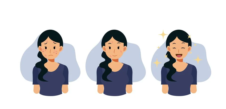 Acne concept.pimples. skin problems. step of Clear of acne.Flat vector cartoo Stock Illustration