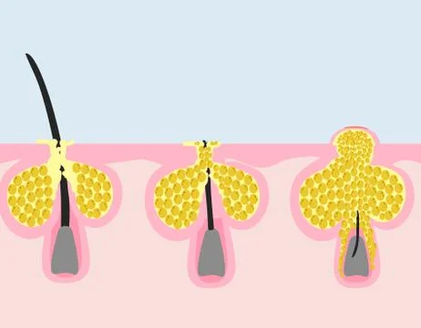 Acne development Stock Illustration