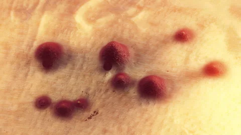 Acne develops, appears on the skin's surface. 3D Render. Pimple problem - Video stock 245471521