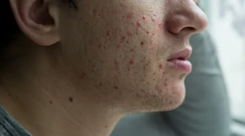Acne on a face of a man 스톡 동영상 59709944