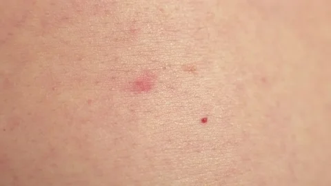 Acne on a fair body, problem skin Stock Footage 147666224