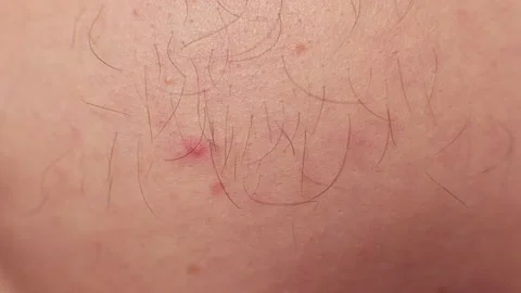 Acne on a fair body, problem skin Stock Footage 147669828