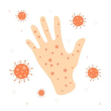 Acne on the hand from MonkeyPox Stock Illustration