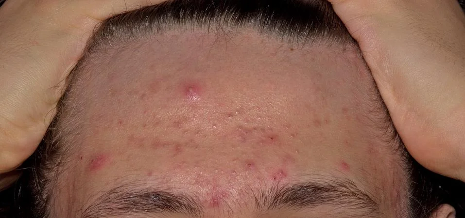 Acne Stock Photos
