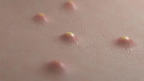Acne pops out of the skin because of clogged pores Stock Footage 258497316