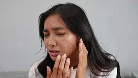 Acne problem. Young unhappy asian woman squeezing pimple on her cheek, looking Stock Footage 332117788