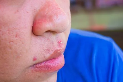 Acne skin because the disorders of sebaceous Stock Photos