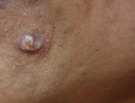 Acne on skin face Stock Photos