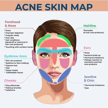 Acne skin map Stock Illustration