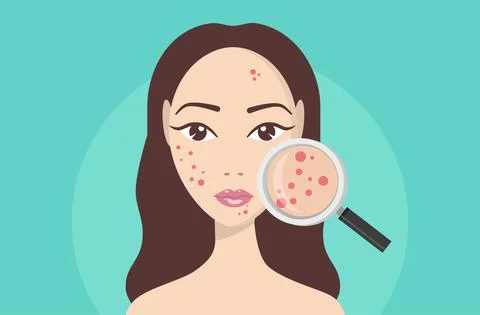 Acne, skin problems, stages of acne. Woman holding magnifying glass for looki Stock Illustration