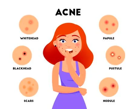 Acne types infographic elements vector flat illustration. Girl with acne on face Stock Illustration