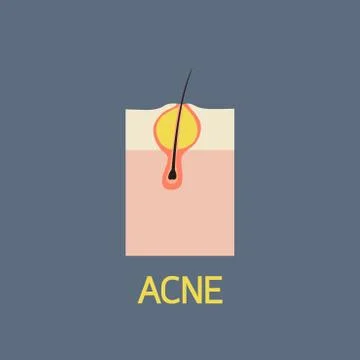 ACNE vector icon illustration Stock Illustration