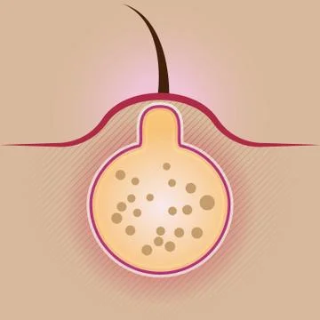 Acne vector illustration Stock Illustration