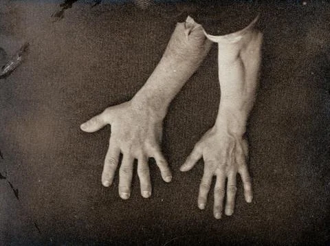Acromegaly: a comparison between a hand enlarged due to a pituitary gland d.. Stock Photos