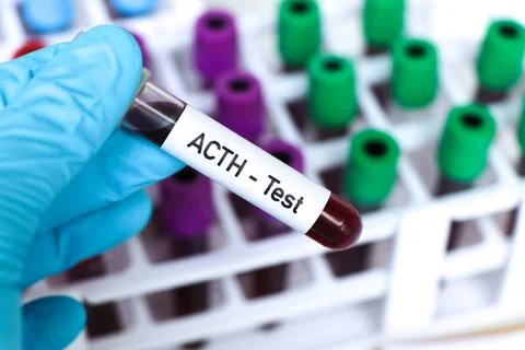 ACTH test, blood sample to analyze in the laboratory Stock Photos