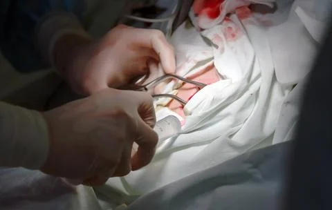 The actual operation to install a pacemaker, incision. Stock Photos
