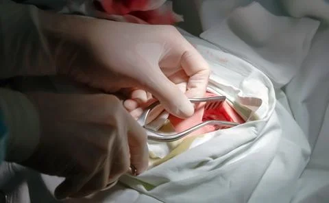 The actual operation to install a pacemaker, incision. Stock Photos