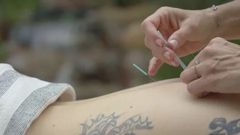 Acupuncture and wellness Stock Footage 82467804
