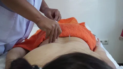 Acupuncture of the back Stock Footage 81787069
