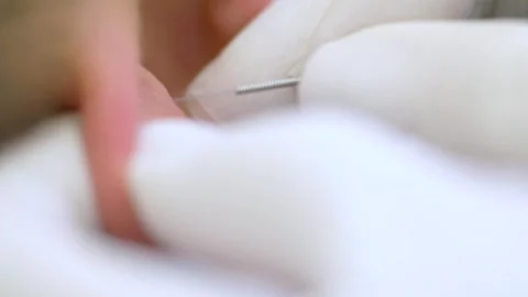 Acupuncture. Close-up of the ear of a man receiving acupuncture treatment at the Stock-Footage 253434295