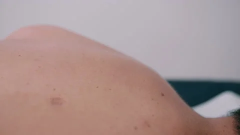 Acupuncture close up, needles being put into skin Stock Footage 131872023