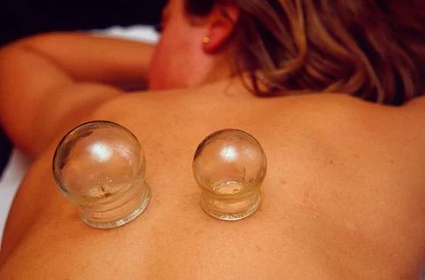  Acupuncture, cupping Ventosa (cupping glasses). Cupping-glass therapy is ... Stock Photos