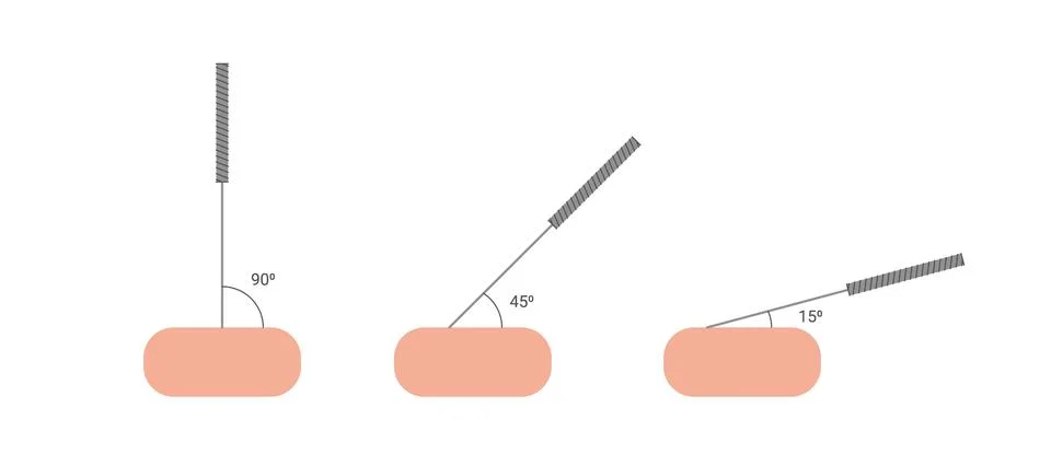 Acupuncture, different angles of acupuncture needle insertion. Alternative Stock Illustration