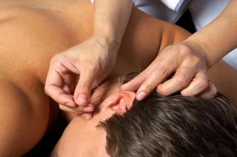 Acupuncture of  ear Stock-Fotos